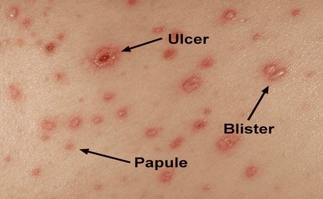 Chicken Pox Disease With Sign Treatment And Nursing Intervention