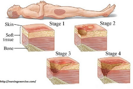 4 Stages Of Bedsore Pressure Sores Complications