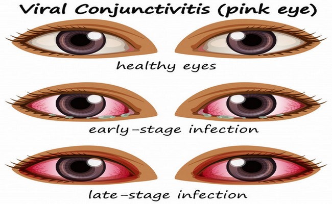 Conjunctivitis disease