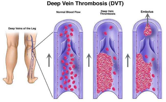 Deep vein thrombosis