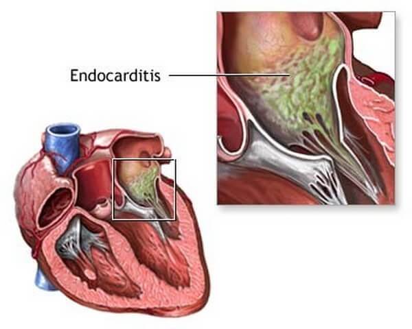 Endocarditis disease