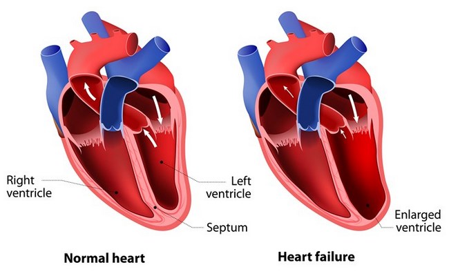 Heart failure disease