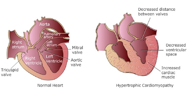 Hypertension disease