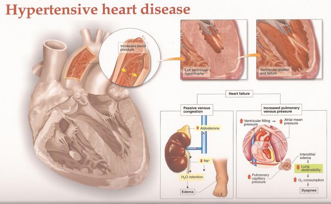 Hypertension disease