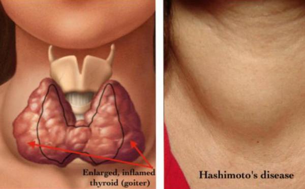 Hypothyroidism disease