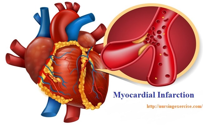 Myocardial Infarction Disease (MI)