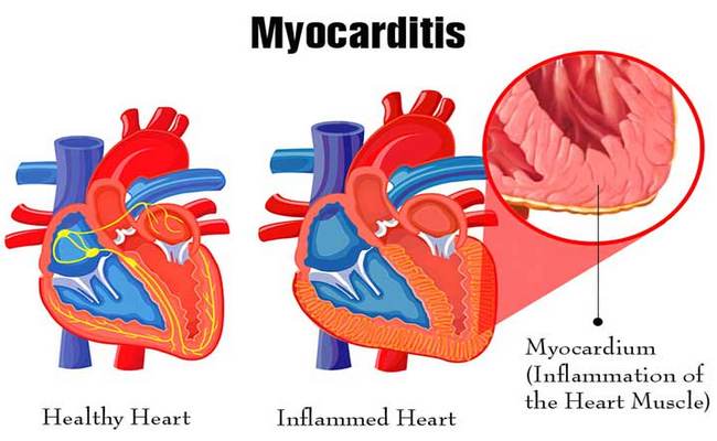 Myocarditis disease