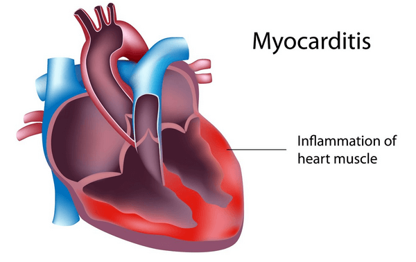 Myocarditis disease