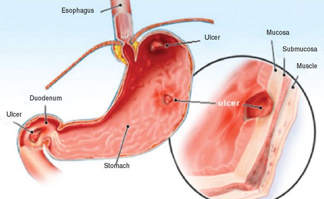 Peptic ulcer disease