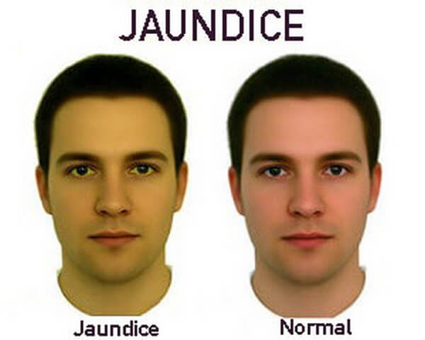Jaundice disease