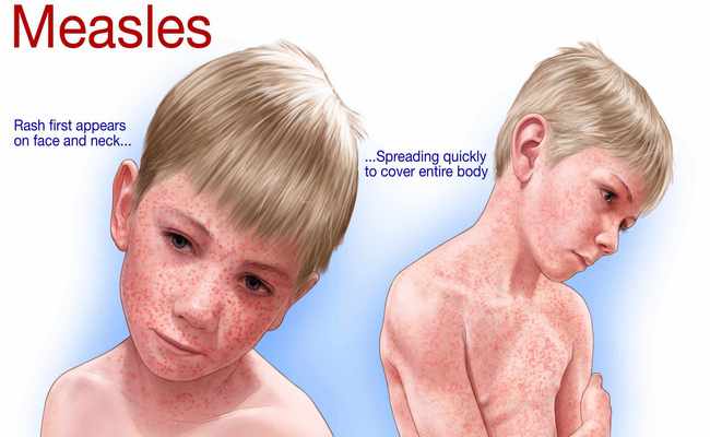 Measles disease