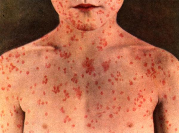 Measles disease