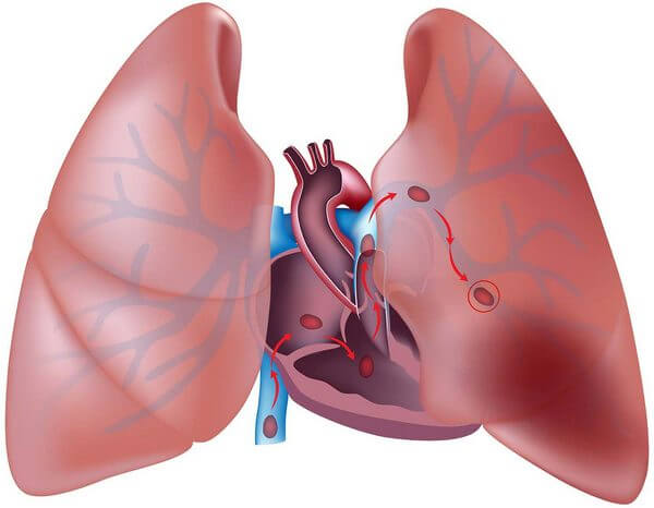 Pulmonary embolism disease