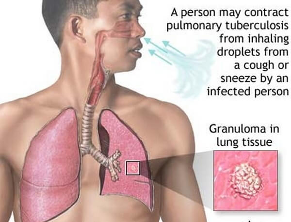 Pulmonary tuberculosis disease