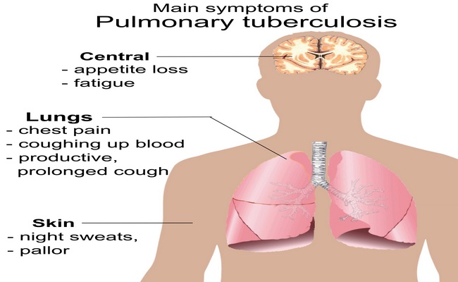 Pulmonary tuberculosis symptoms