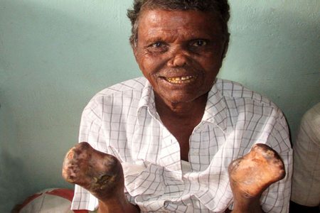 Complication of leprosy disease