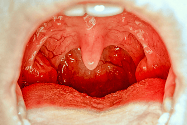 Tonsillitis Disease