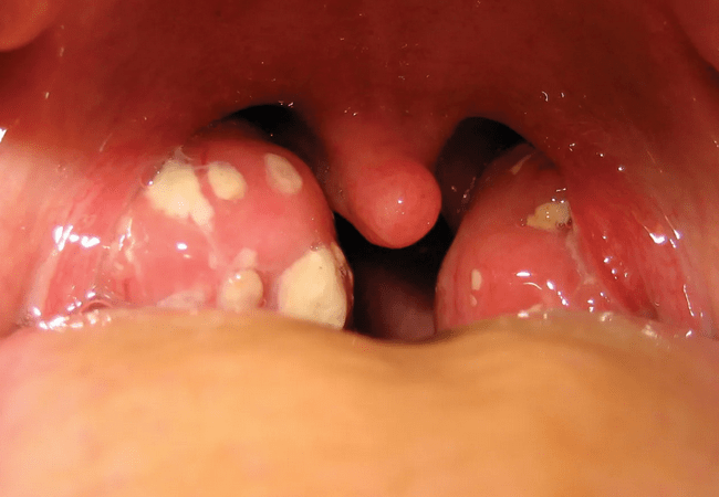 Tonsillitis Disease