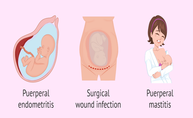 Puerperal sepsis fever