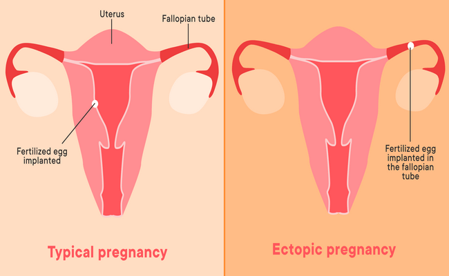Main causes of ectopic pregnancy