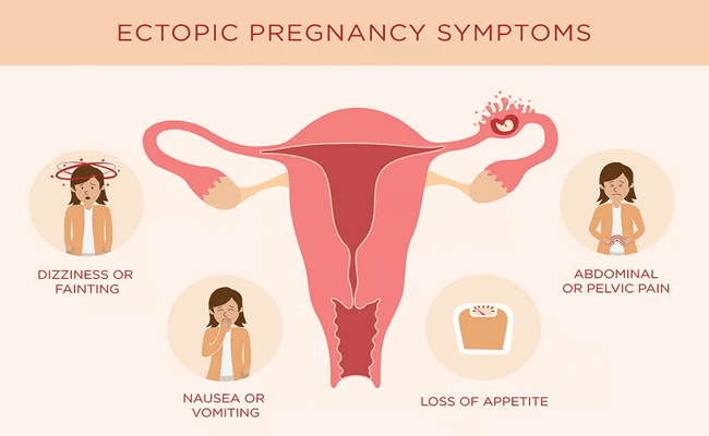 Symptoms of ectopic pregnancy