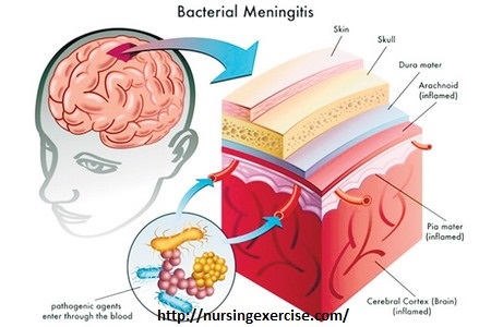 Meningitis sign and symptoms