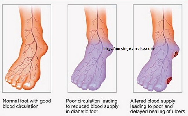 Poor blood circulation