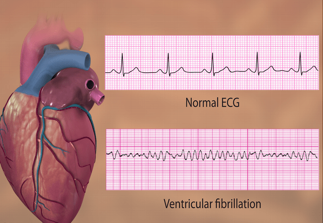 Ventricular fibrillation