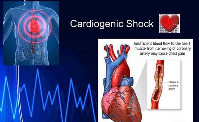 Cardiogenic Shock