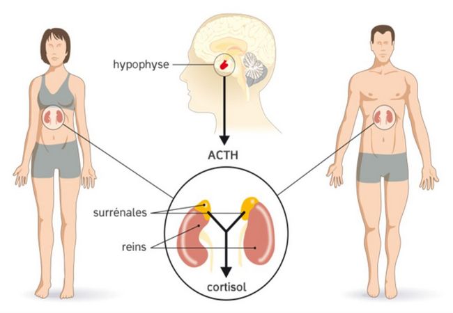 Cushing Syndrome