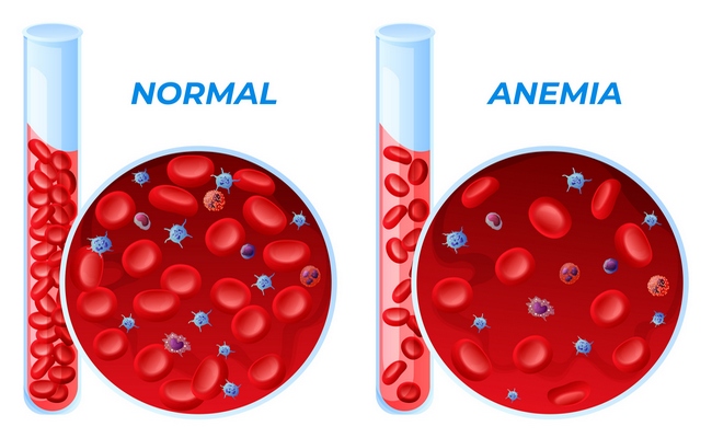 Anaemia or Anemia