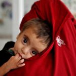 Malnutrition in children