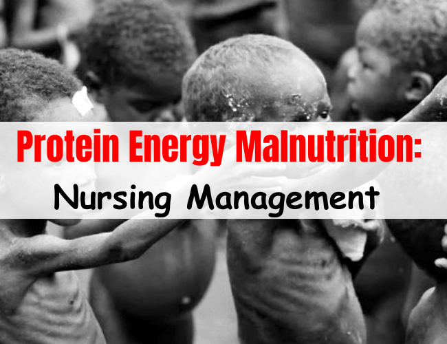 Nursing management of protein energy malnutrition (PEM)