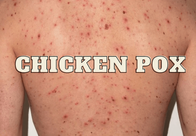 Chickenpox disease