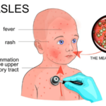 Measles disease symptoms