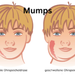 Mumps disease