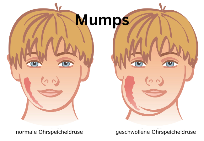 Mumps disease