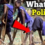 Poliomyelitis or Polio
