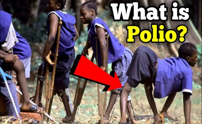 Poliomyelitis or Polio