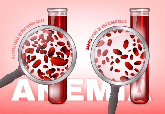 Classifications of Anaemia or Anemia