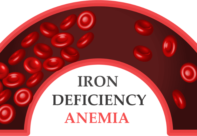 Iron deficiency anemia or anaemia in children