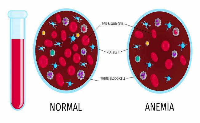 Sign symptoms of anaemia or anemia