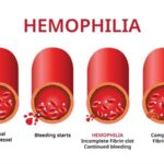 Hemophilia Disease