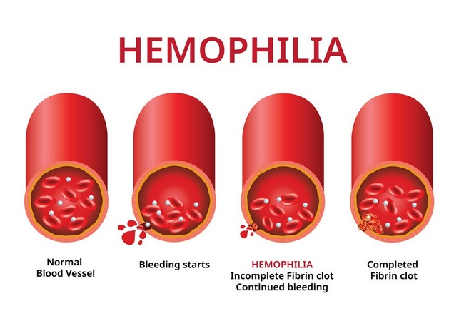 Hemophilia Disease