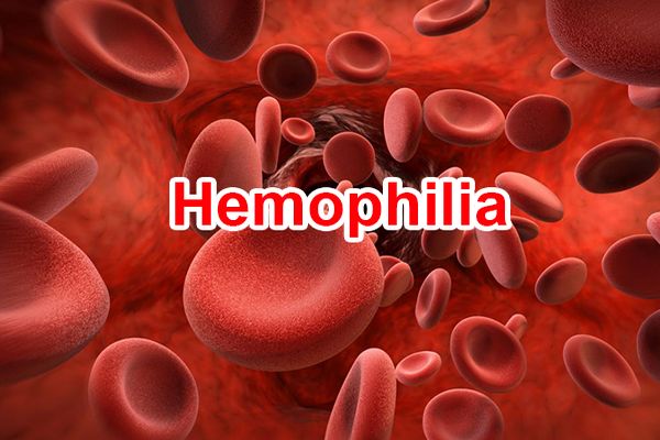 Nursing management of hemophilia