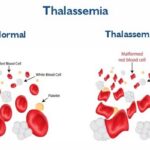 Thalassemia disease